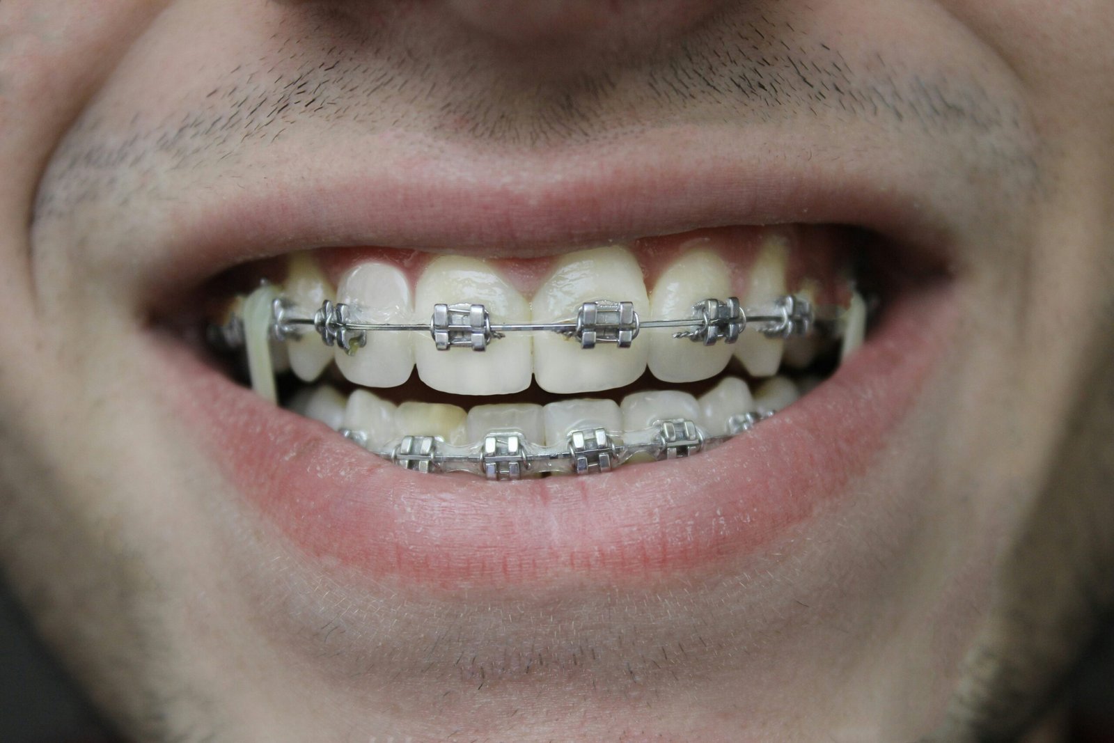 underbite